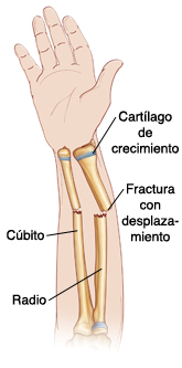 Krames Online Si Su Hijo Tiene Una Fractura Del Antebrazo