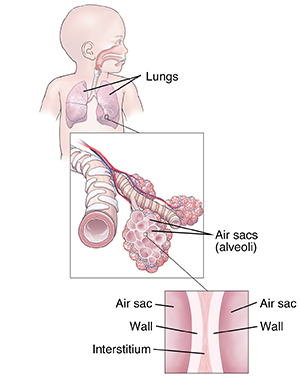 Front view of infant showing respiratory system. Inset shows bronchiole and alveoli. Second inset shows extreme closeup of interstitial tissue between two alveoli.