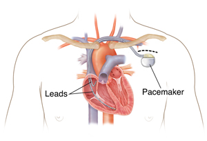 Outline of person's chest showing pacemaker in chest with two leads going into heart chambers.