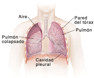 Vista frontal del pecho de un hombre que muestra el pulmón derecho parcialmente colapsado.