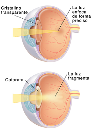 Vista de tres cuartos de un ojo donde puede verse el cristalino que enfoca la luz con nitidez. Vista de tres cuartos de un ojo donde puede verse que una catarata difumina la luz.