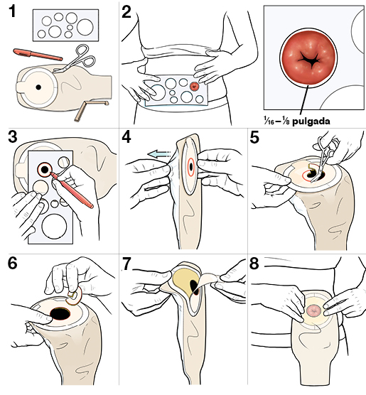 8 pasos para medir la abertura de un estoma.