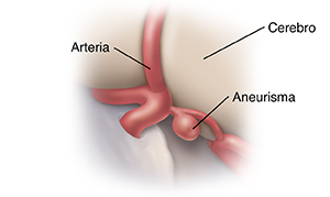 Primer plano de un aneurisma cerebral.