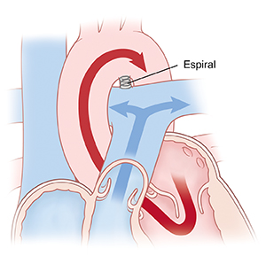 Primer plano de un conducto arterioso permeable en donde se ve un espiral que lo cierra.