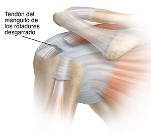 Vista frontal de la articulación del hombro donde se observa el desgarro del tendón del manguito rotador.