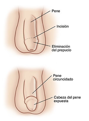 Vista frontal del pene y del escroto, donde se observa el lugar de la incisión de la circuncisión. Vista frontal del pene y del escroto, que muestra el pene después de la circuncisión sin el prepucio.