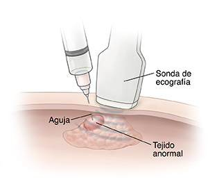 Primer plano de una aguja introducida en un tejido anormal para hacer una biopsia. Sonda de ecografía sobre una superficie de piel.